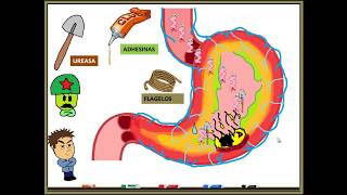 HELICOBACTER PYLORI GASTRITIS [upl. by Mcleroy]